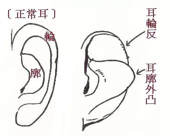 反廓耳|五官面相学：耳朵看相，耳朵的形状及吉凶断法